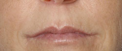 Lines and Wrinkles on the Upper Lip and Around the Mouth Explained – Caci